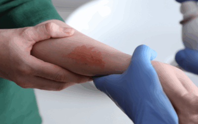 Brûlures mineures dans l’Hérault : Soins rapides avec Censomed