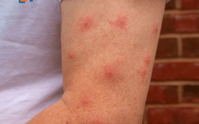 Piqûres d’insectes et allergies légères dans l’Hérault : Censomed à votre secours