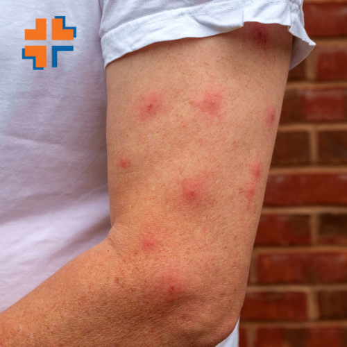 Piqûres d’insectes et allergies légères dans l’Hérault : Censomed à votre secours